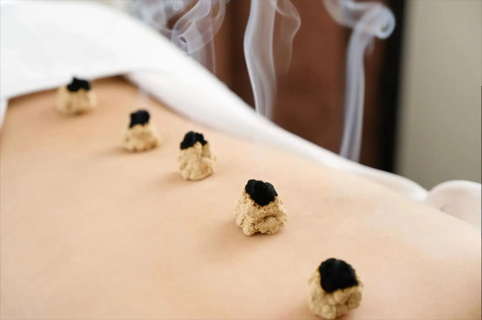 Tout savoir sur la moxibustion